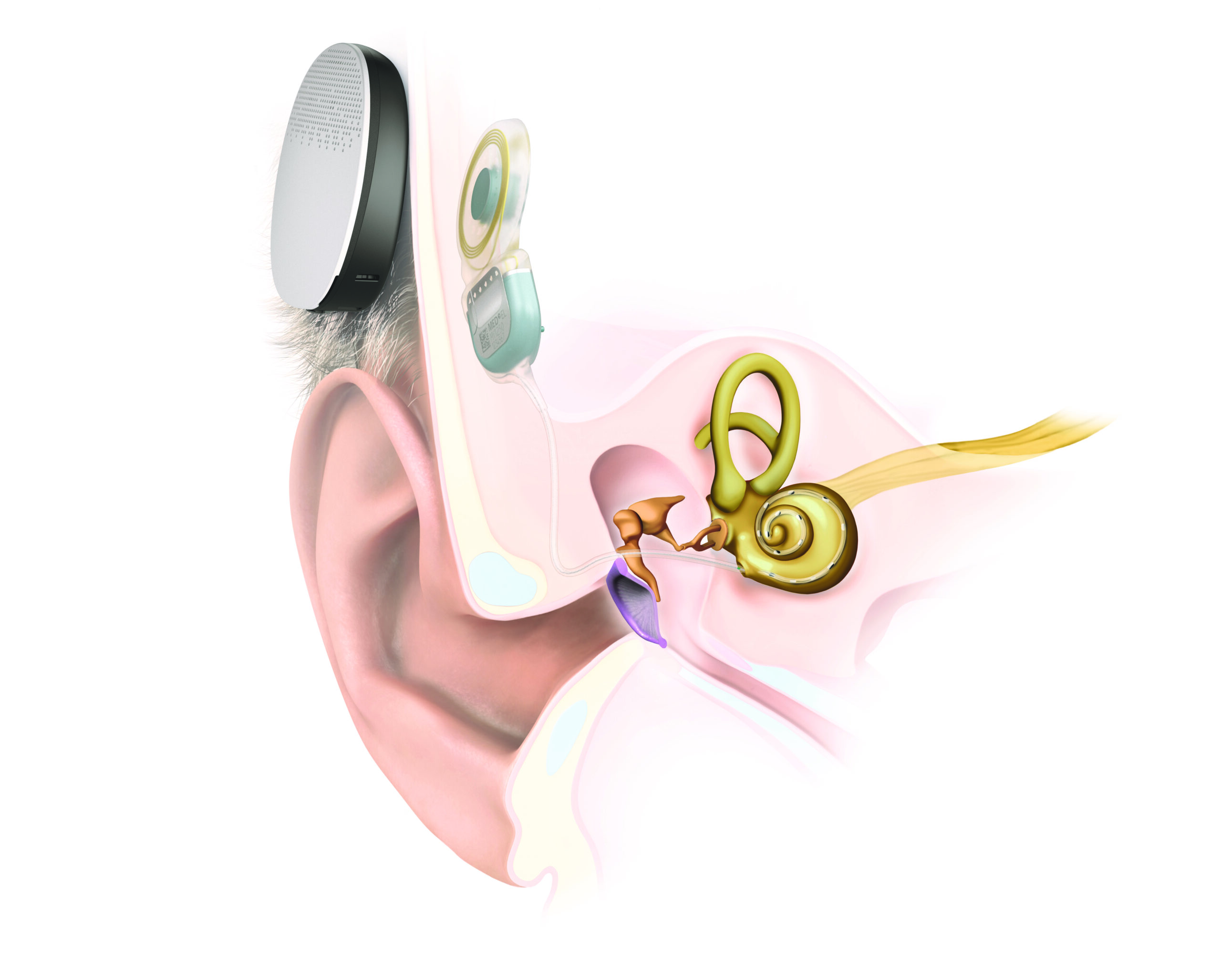 Wie funktioniert ein Cochlea Implantat